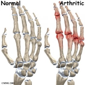 Autoimmune Condition - Osteoarthritis...